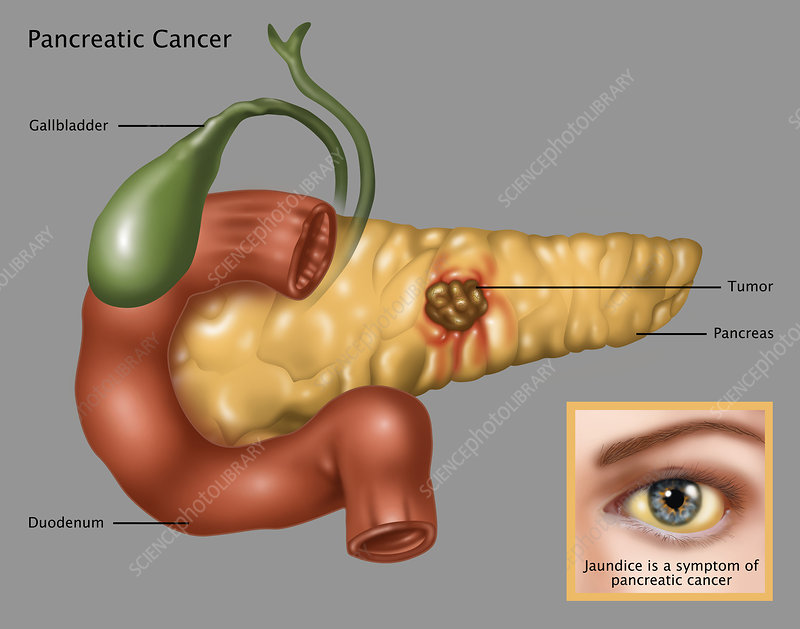 Minh họa vị trí tuyến tụy và khối u (giáo dục y khoa). Nguồn: Science Photo Library